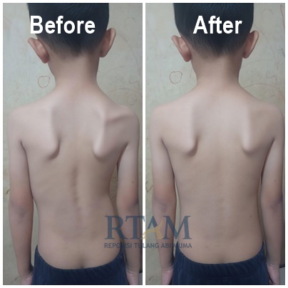 Before After Skoliosis Kasus 2